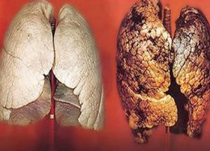 Báo động về căn bệnh ung thư phổi