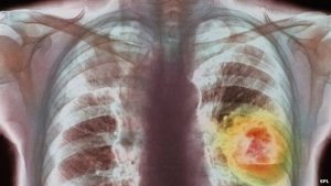 Ung thư phổi tàn phá cơ thể như thế nào?