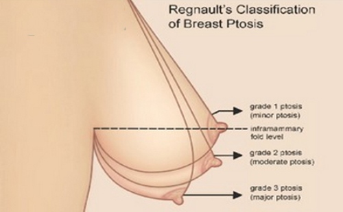 Ngực chảy xệ sau sinh có 3 mức độ khác nhau
