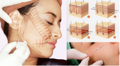 Phương pháp căng da mặt bằng chỉ hiện đại