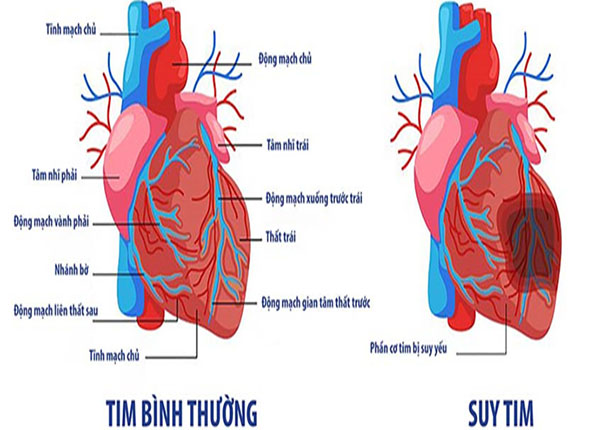 Suy tim là gì? Nguyên nhân và mức độ nguy hiểm của suy tim