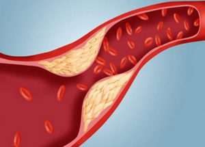 Các yếu tố khiến nồng độ Cholesterol trong máu cao