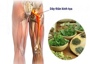 Một số bài thuốc Đông y hỗ trợ điều trị bệnh đau dây thần kinh tọa